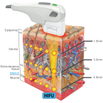 hifu