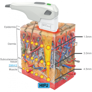 Système Hifu