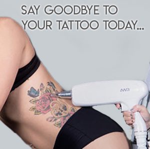 Máquina de remoção de tatuagem
