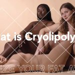 What is Cryolipolysis?
