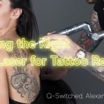 How to choose right laser tattoo removal