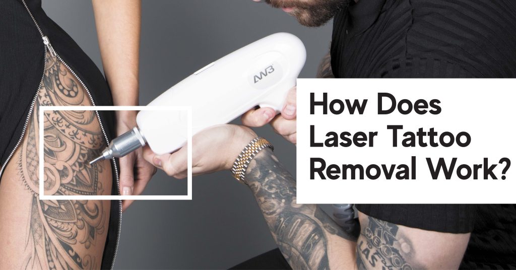 xóa hình xăm diễn ra như thế nào