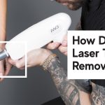 how does tattoo removal work