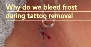 why do we bleed frost during tattoo removal