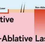 Laser xâm lấn và Laser không xâm lấn