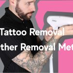 Laser tattoo removal vs other tattoo removal methods
