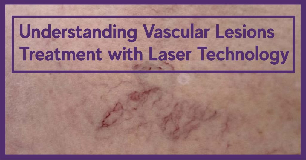 traitement au laser des lésions vasculaires