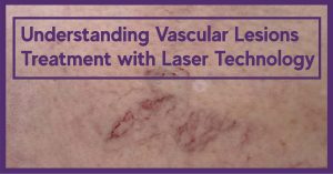 laser treatment for vascular lesions