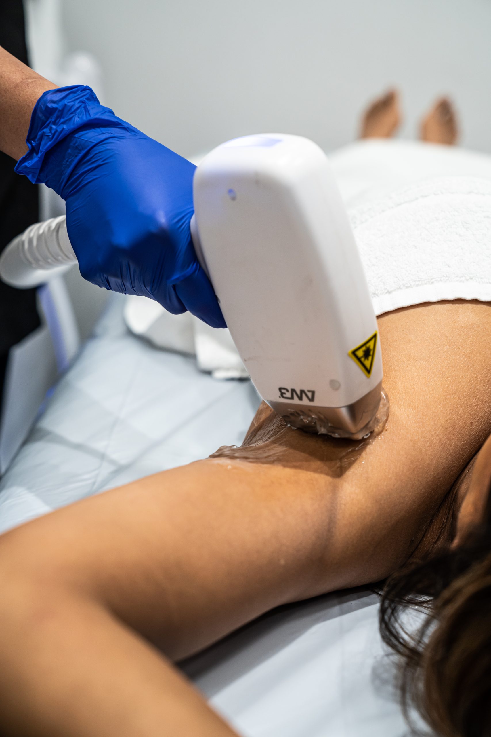 hypertricosis and laser hair removal
