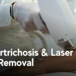 Hypertrichosis and Laser Hair Removal