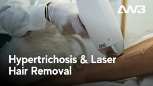 Hypertrichosis and Laser Hair Removal
