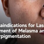 Contraindications for Laser Treatment of Melasma and Hyperpigmentation
