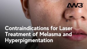 Contraindications for Laser Treatment of Melasma and Hyperpigmentation