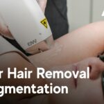 Laser Hair Removal and Pigmentation